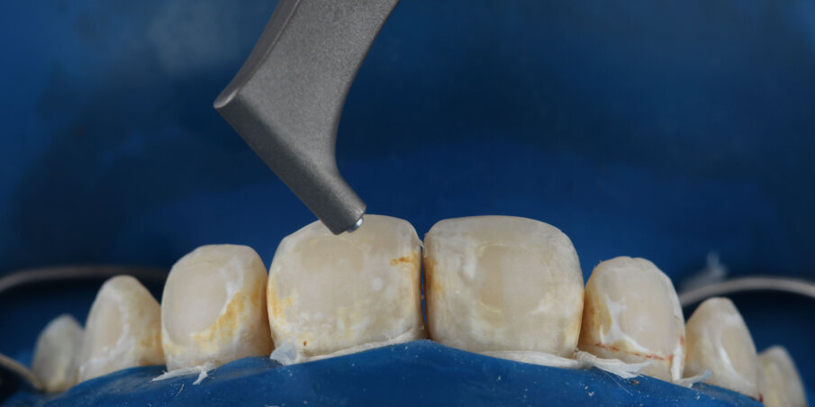 Case 3: Used before ICON Infiltration procedure