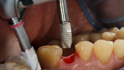 Long-term study investigates risk factors for short dental implants