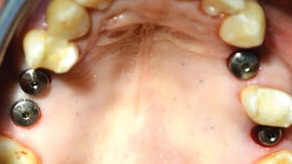 Safe, accurate, simplified sinus-lift technique for general practitioners, Part 2: Introduction of surgical technique