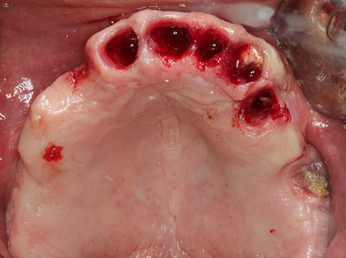 Fig. 7. Exodoncia de los dientes y explantaciÃ³n del implante 24. Se observa fractura del diente 23 y exposiciÃ³n del material de injerto contaminado del seno maxilar izquierdo. 