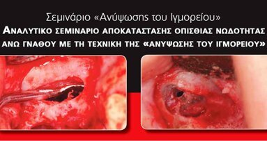 Σεμινάριο ανύψωσης του ιγμορείου