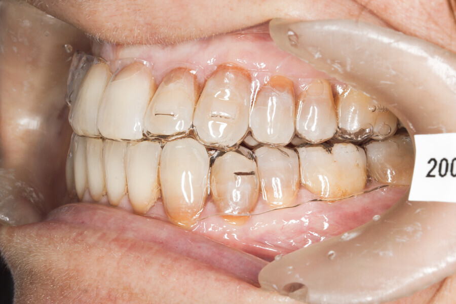 Fig. 40: Intermediate stage of Reveal aligners. Aligner #32.