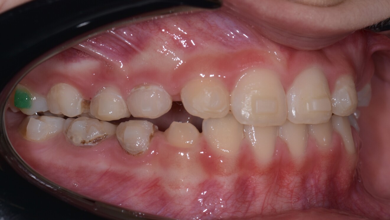 Figs. 2d–h: Post-treatment records. Intra-oral photographs.