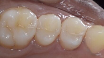 Keys to predictable posterior restorations: Bulkfill and modern matrix systems