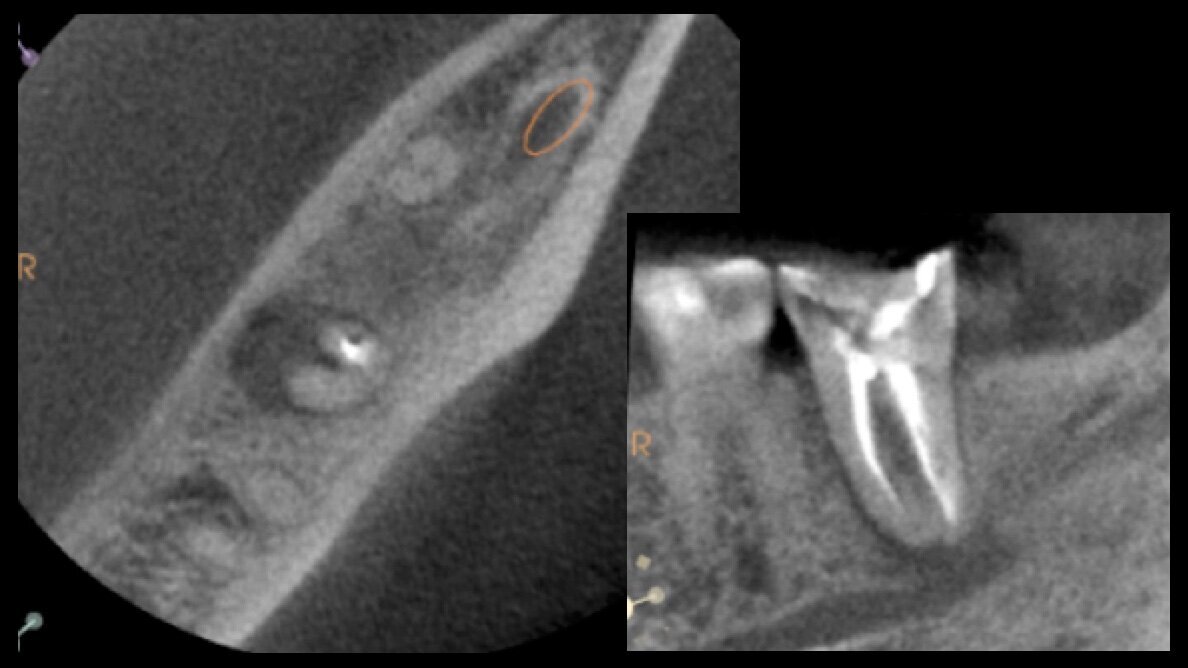 Técnica de Reimplante Intencional Digital para salvar dientes