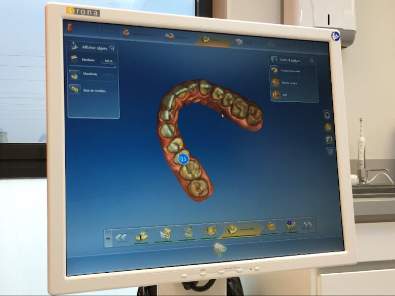 Fig. 9. Imagen de la arcada tomada con el escáner intraoral CEREC.