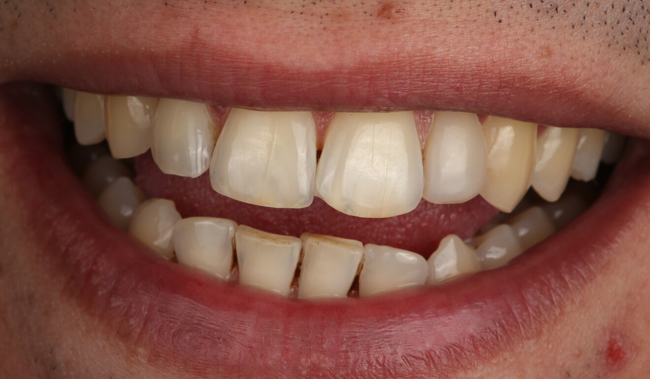 Fig. 9: Restoration six months after treatment.