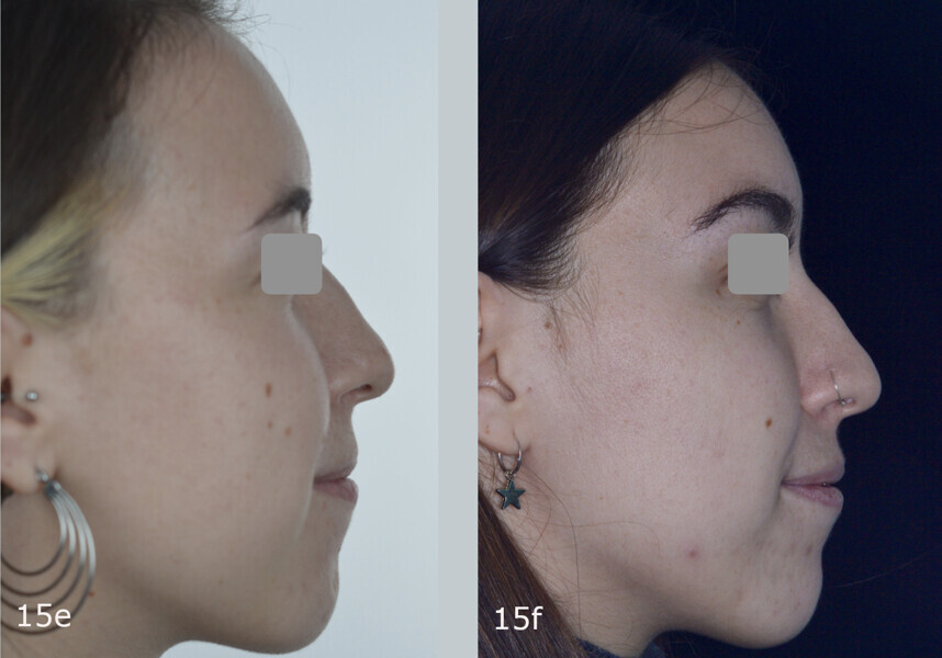 Figs. 15a–f: Extra-oral comparison of the situation (a, c & e) before and (b, d & f) after treatment. The mandibular deviation and the lower face height had been slightly corrected.