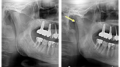 Zastosowanie współczesnych metod diagnostycznych w postępowaniu ze złamaniem CBCT – opis przypadku