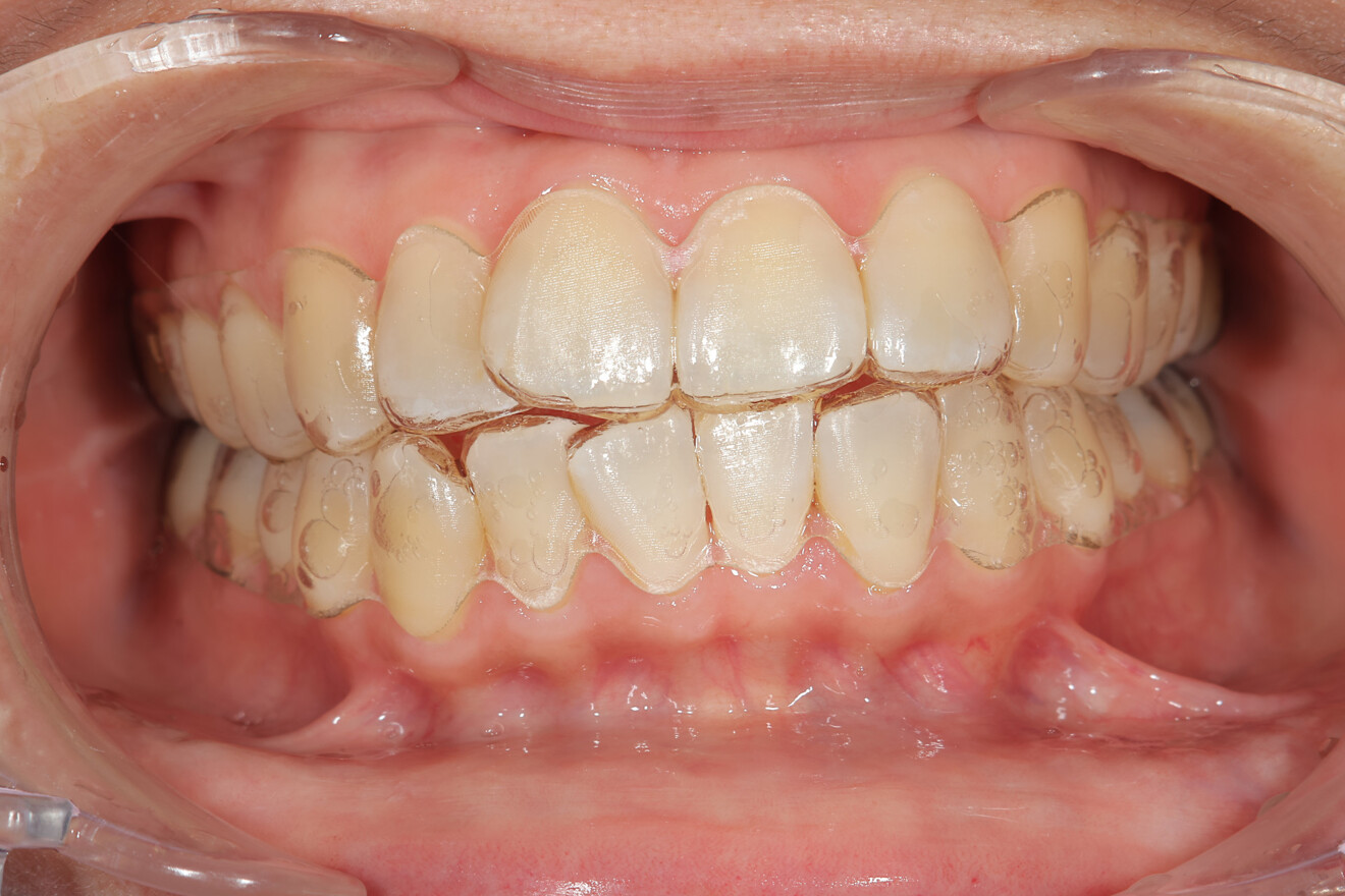 Fig. 6c: Aligners shown intra-orally.