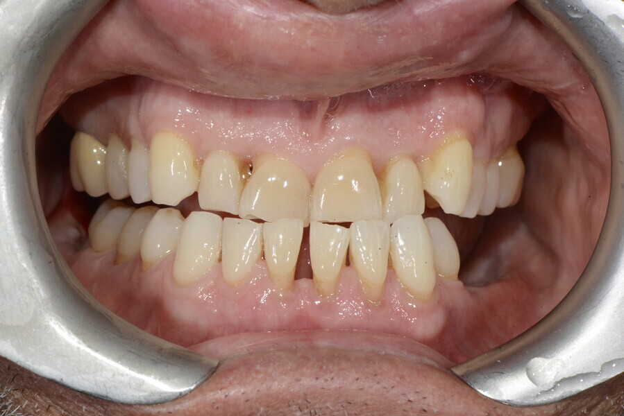 Figs. 17a–g: Situation after aetiological periodontal therapy and several tooth extractions to address the periodontal problems but before orthodontic treatment.