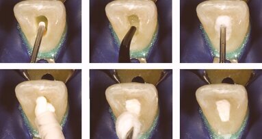 El aclaramiento dental no es un juego