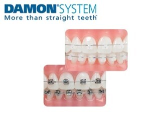 Ormco Damon System
