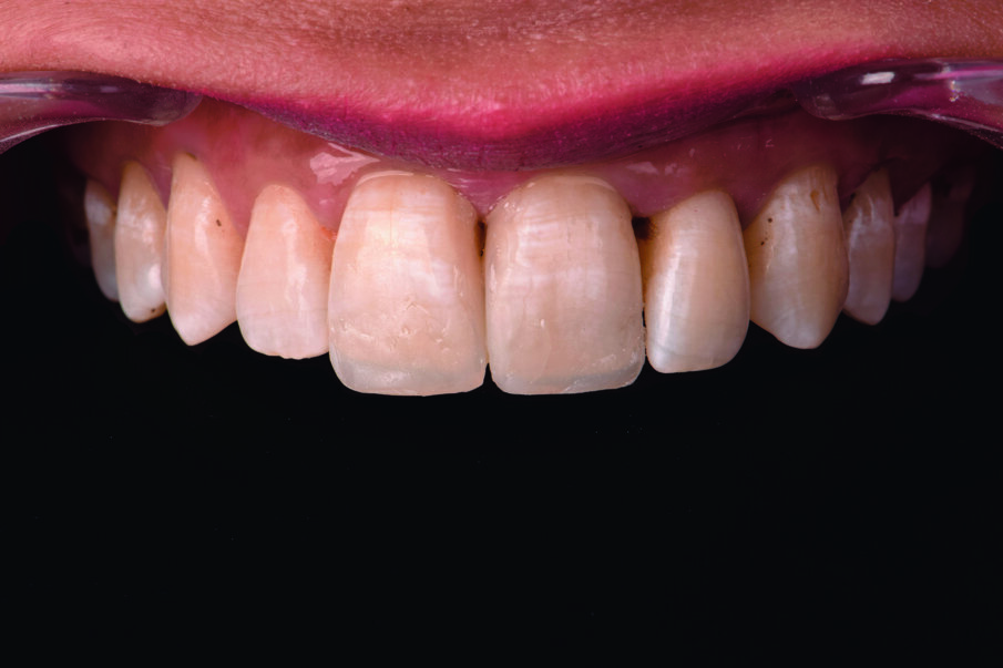 Fig 3. after prepless direct mock up