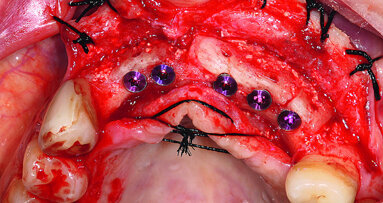 Implant retreatment