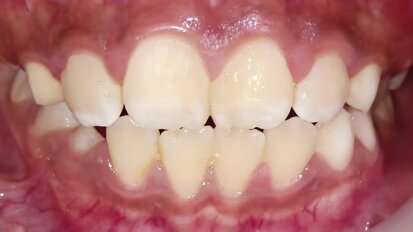 El Síndrome Periodontal No Carioso