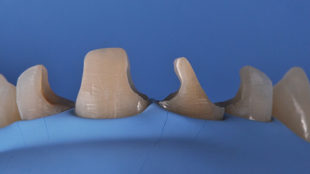 Prepared teeth and isolated working field prior to treatment using BEST.FIT.