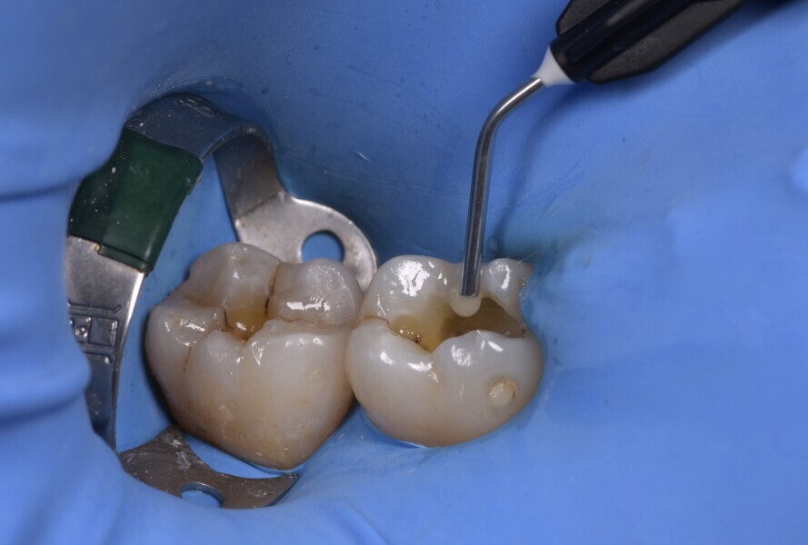 Fig. 4: Filling procedure: application of the first layer of flowable composite. 