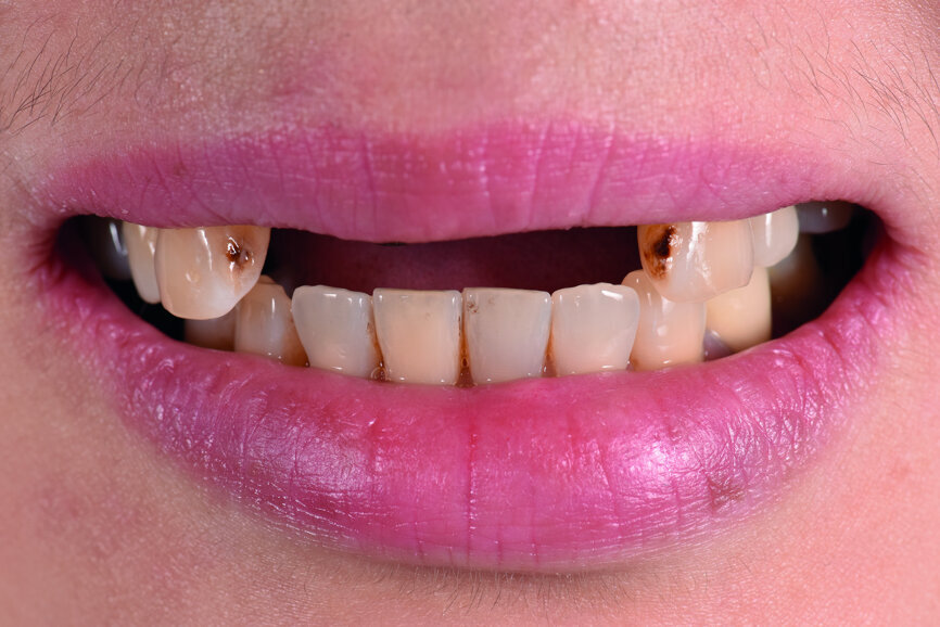 Fig. 9: Patient smiling three months post-op.