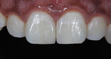 Direct composite restorations in maxillary central incisors with unequal mesio-distal width.
