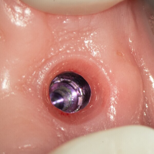Fig. 2b: Health of the soft tissue after removal of the healing abutment. 