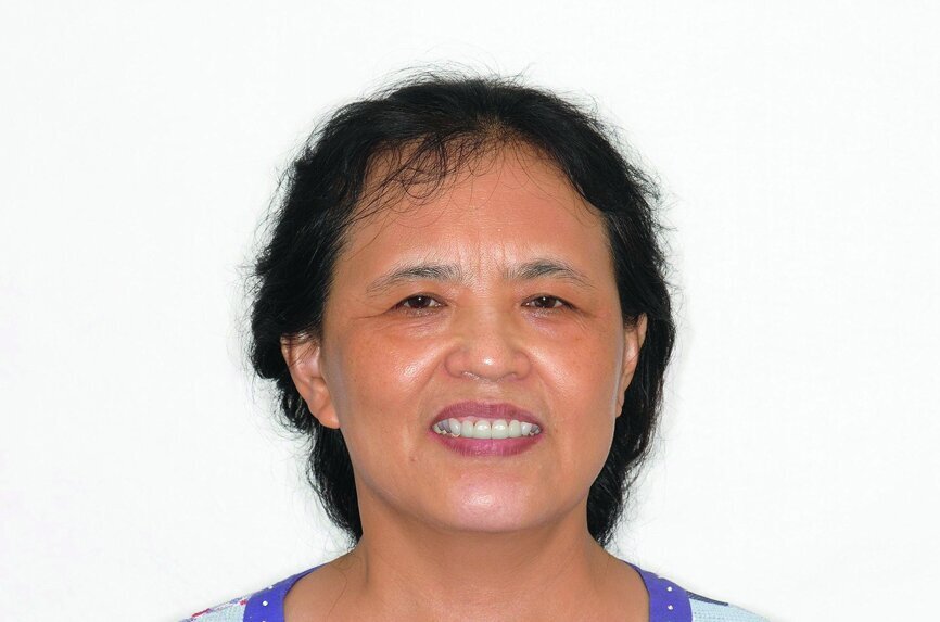 Fig. 10: DSD smile view pre-operation.