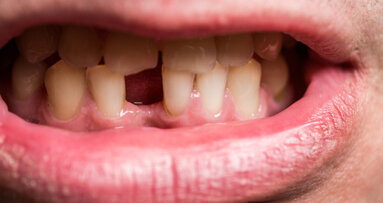 Smoking cessation may decrease risk of tooth loss