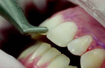 Fig. 5: Removal of biofilm under the gingiva (sulcus < 4 mm). Technically correct work is indispensable for successful air polishing: Setting the power to 30-50%, water flow to 100%