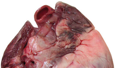 Coronary heart disease patients with no teeth have nearly double risk of death
