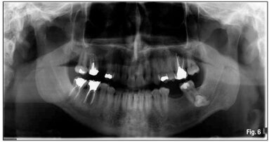 Cutaneous sinus tracts: An endodontic approach