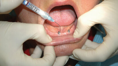 Zuverlässig Periimplantitis bekämpfen