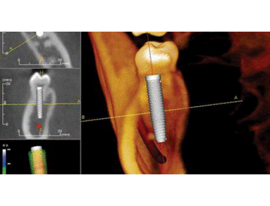 Le cone beam et les implants : une expérience qui change une carrière