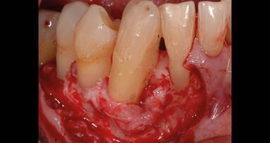 L’azione del gel di xantano e clorexidina come complemento ai trattamenti chirurgici parodontali