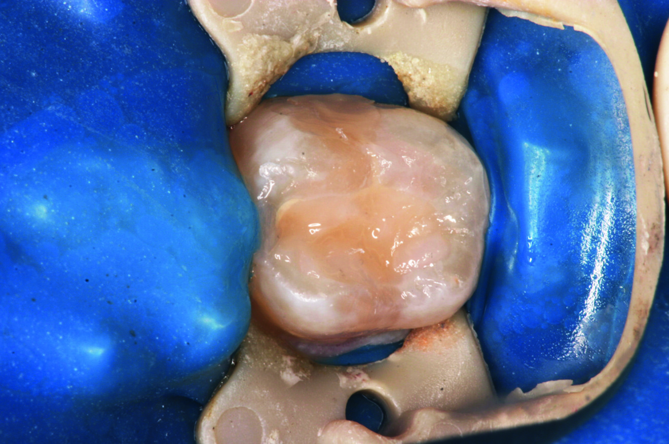Fig. 7 : Mise en place du composite.