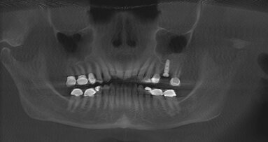 The evolution of sinus lift techniques