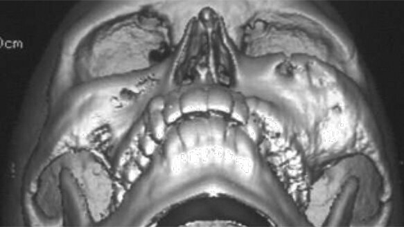 Interview: Diagnosing fibro-osseous lesions
