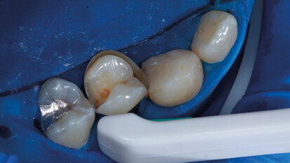Case report. Restauro eseguito utilizzando le matrici Pro-Matrix e il composito Enamel Plus HRi