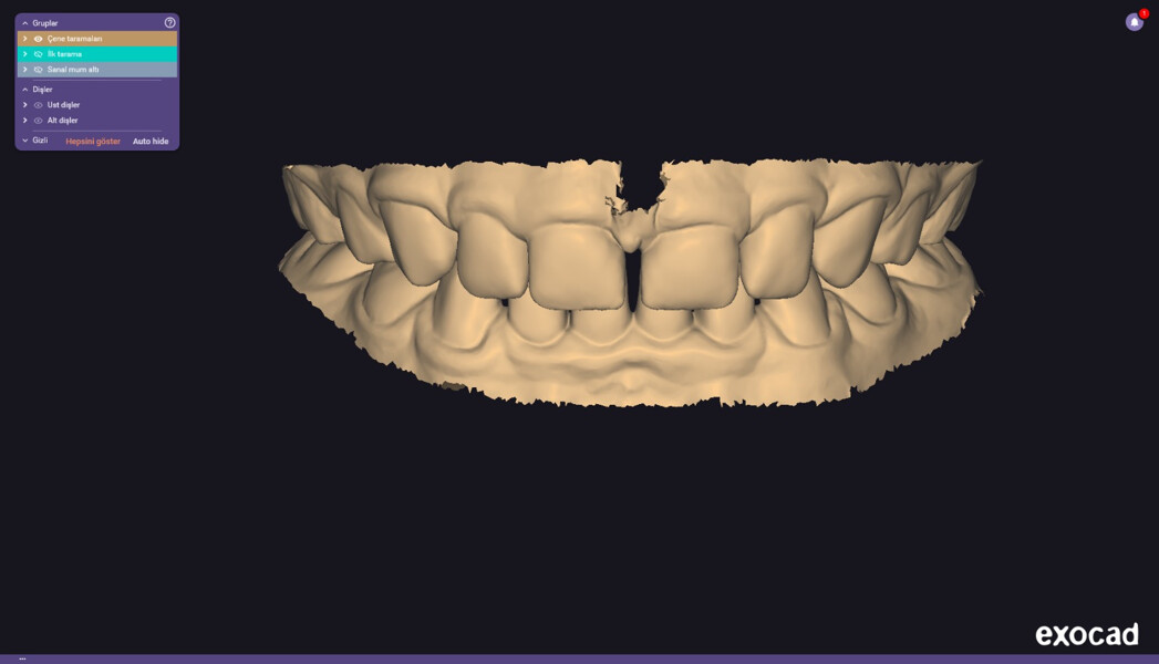 Figs. 2a–k: Initial digital design with increased vertical dimension of occlusion.