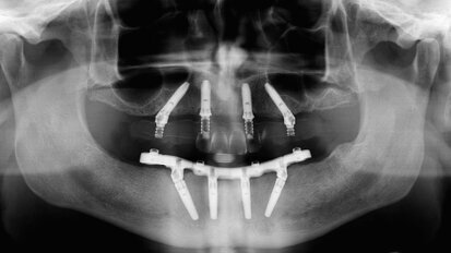 Three-year clinical and radiographic outcomes of patients treated according to the All-on-4 concept in the daily practice: A prospective observational study on implants and prosthesis survival rates and complications