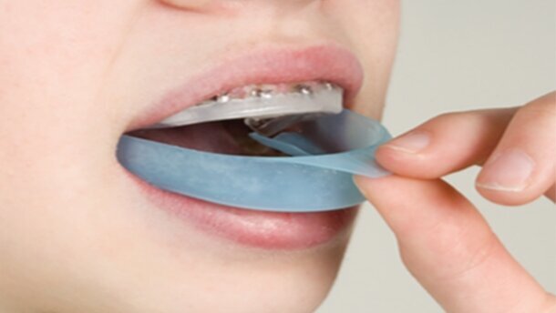 First Whitener for Fixed Braces Orthodontics