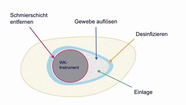 Die Desinfektion des Wurzelkanals