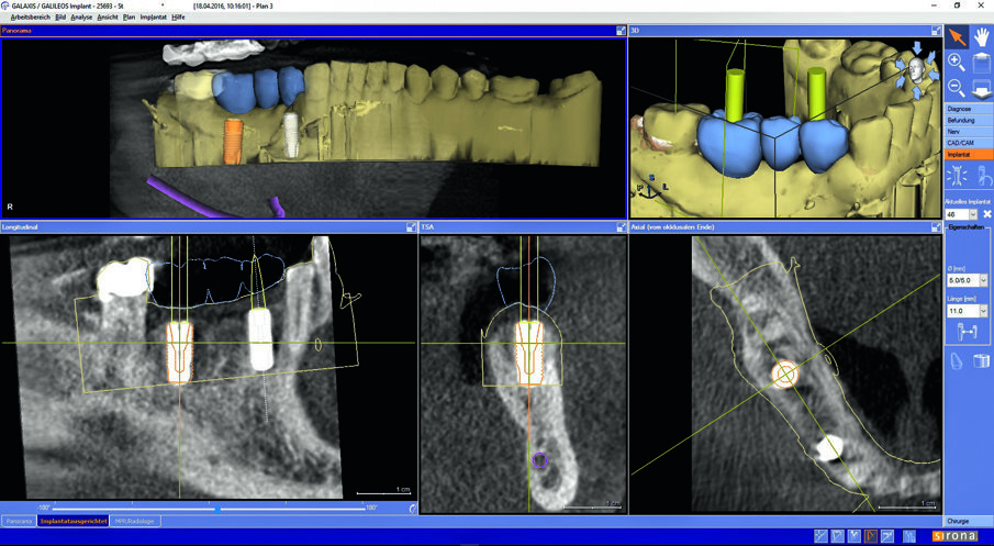 By means of a low-dose recording, the implant was checked three-dimensionally.