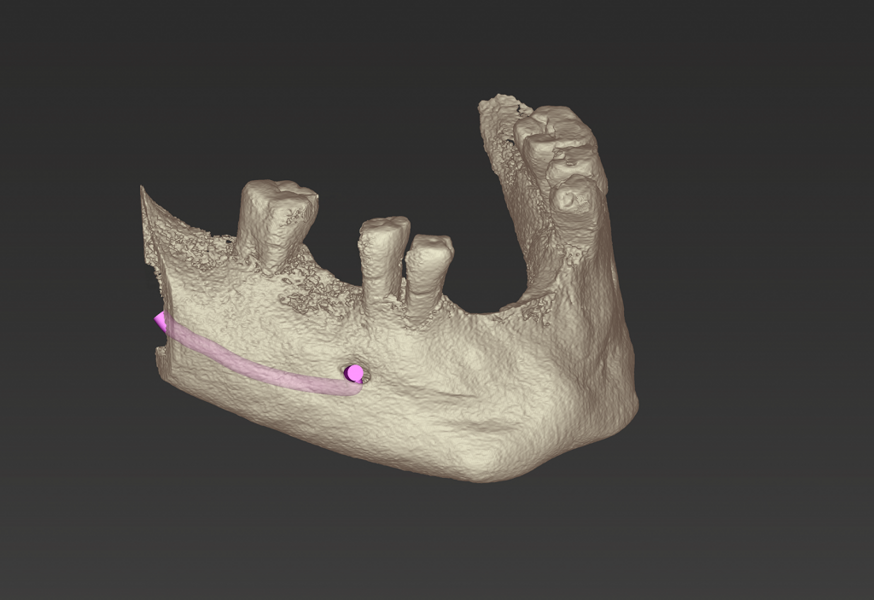 coDiagnostiX-3D visualization of the bone