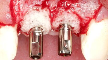 Augmentation: Specialist presents bone ring technique