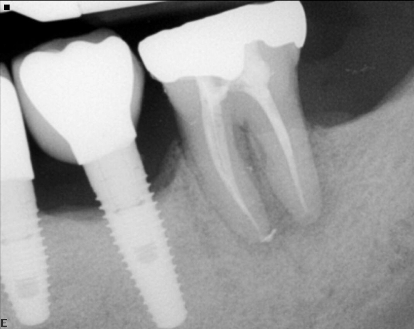 Fig. 11: Post-op radiograph after removing the calcification and achieving 3D vertical obturation.