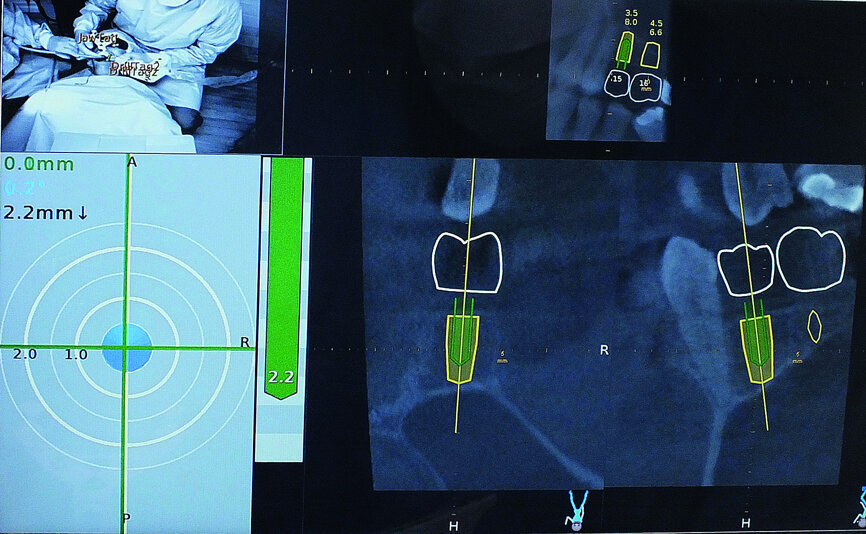 Fig. 7: The pathway of the drill could be followed clearly on the Navident computer screen.