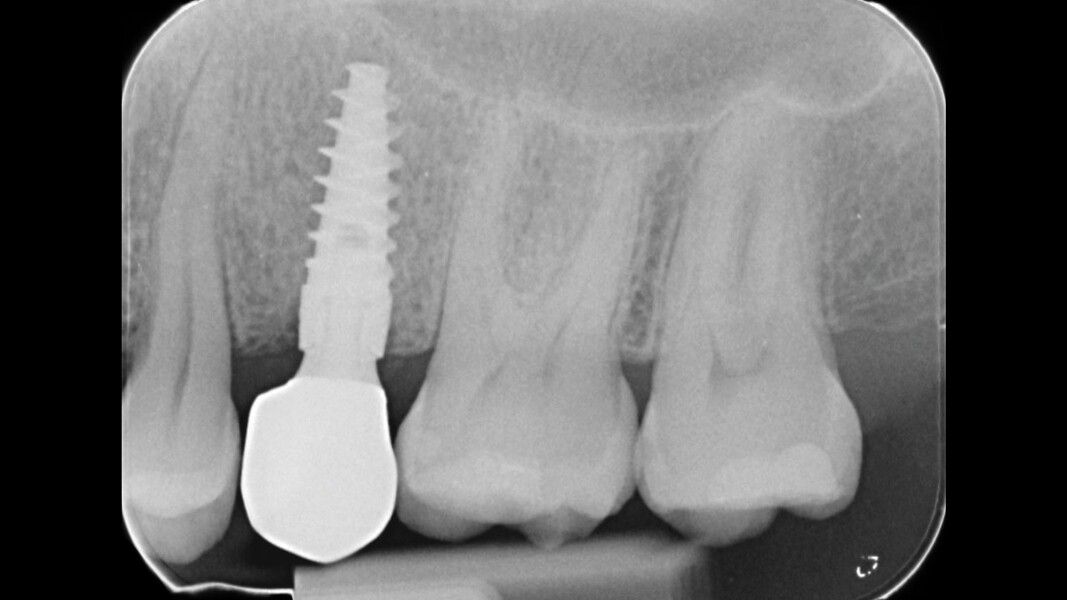 Fig. 9_RX finale.