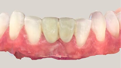 Optimising design and shade—replacement of a resin-bonded bridge for aesthetic reasons