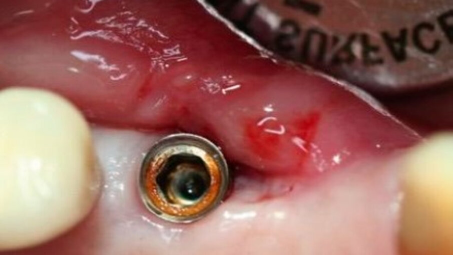 Obr. 2a: Koroze na implantátech a třmenu. Koroze na spojení mezi implantátem a abutmentem (a).