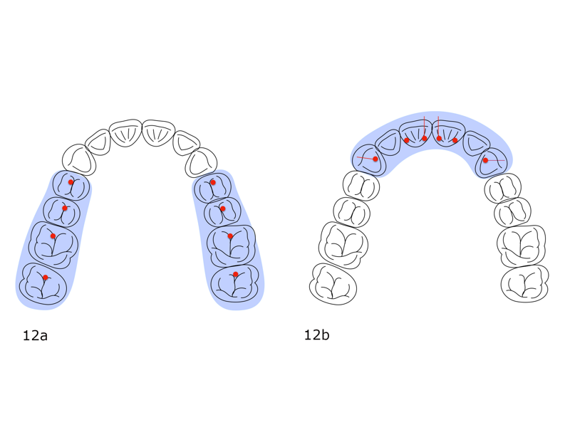 Figs. 12a & b: Diagram of ideal contacts on the splint. (a) Posterior contact. (b) Anterior contact and guidance.